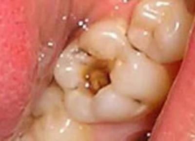 ریشه اصلی پوسیدگی دندان کجاست ؟