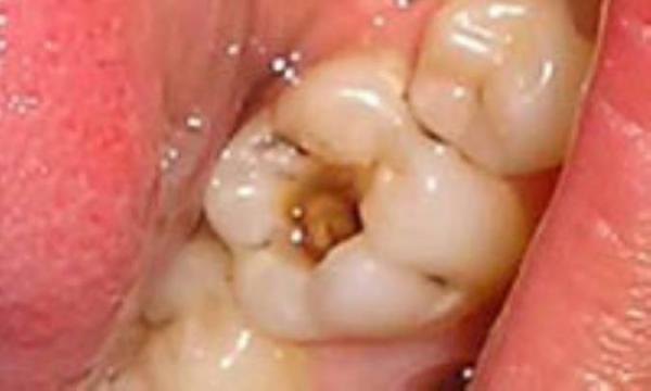 ریشه اصلی پوسیدگی دندان کجاست ؟