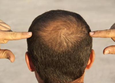درمان نو ریزش موها: آزمایش دانشمندان بر روی یک دستگاه کوچک پوشیدنی